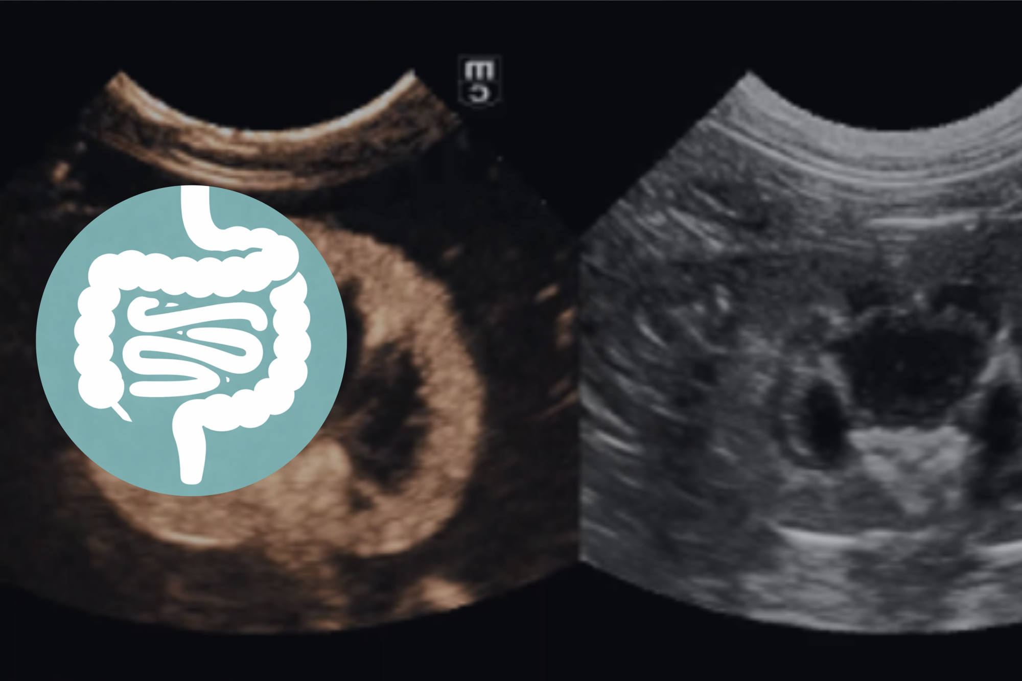 Echo abdomen basic: module 2